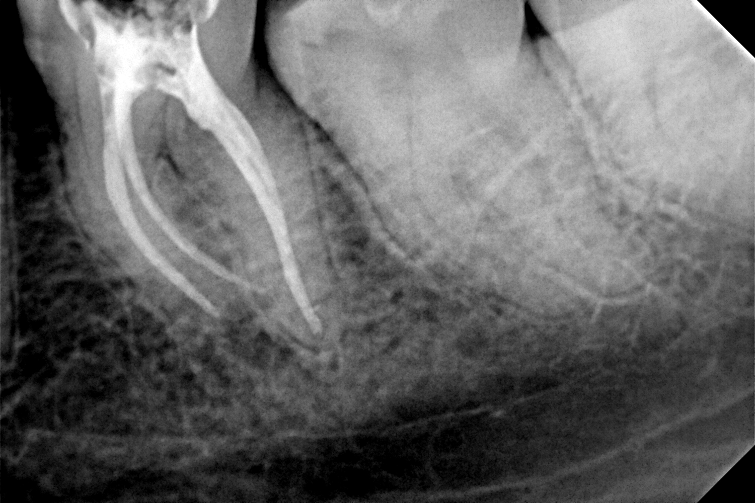 przypadek-1.-po-leczeniu-endodontycznym