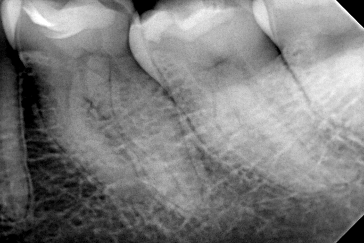 przypadek-1.-przed-leczeniem-endodontycznym (1)