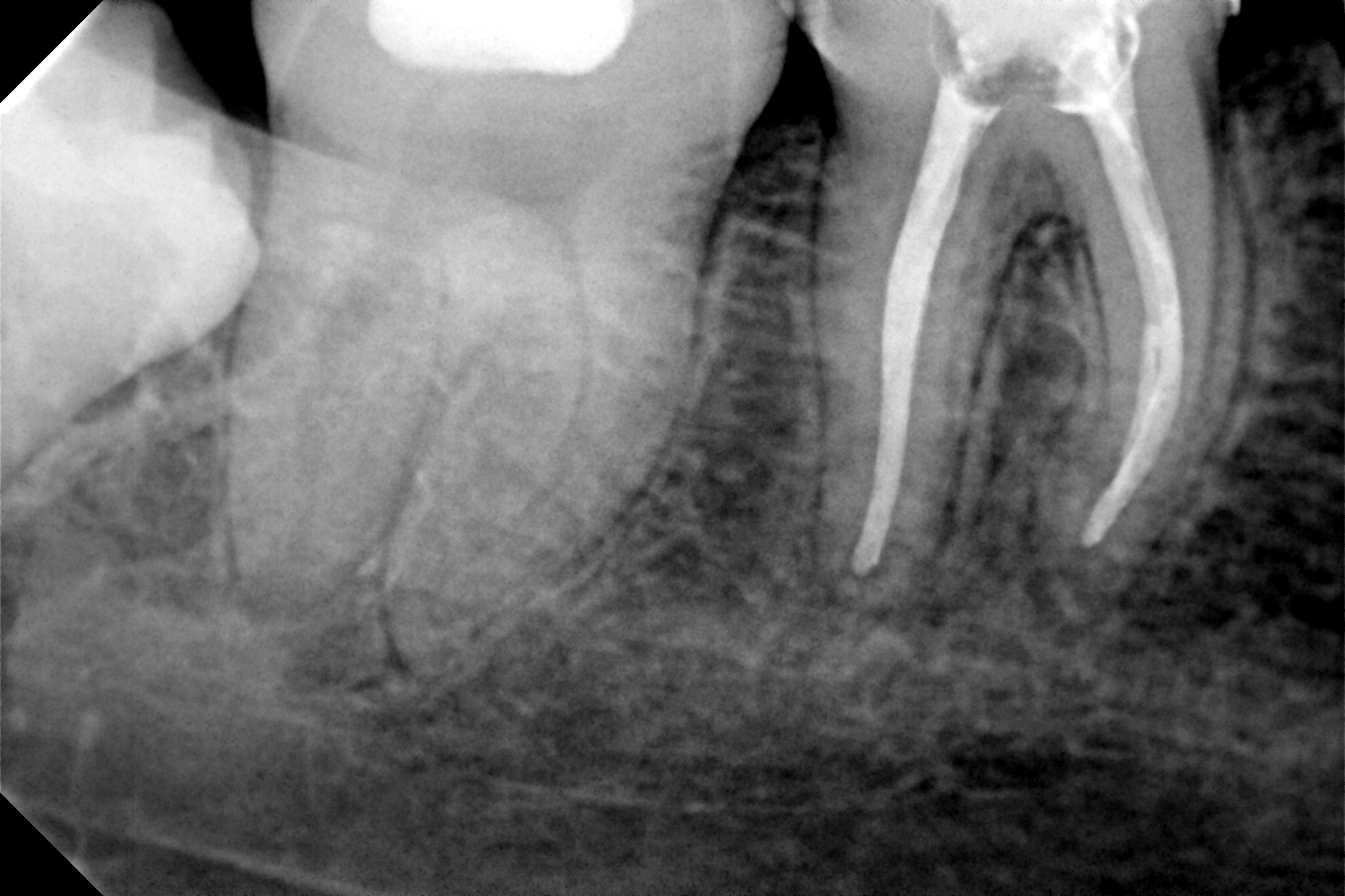 przypadek-2.-po-leczeniu-endodontycznym