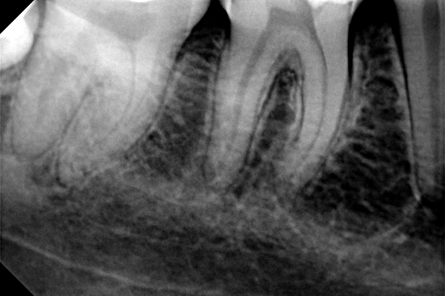 przypadek-2.-przed-leczeniem-endodontycznym