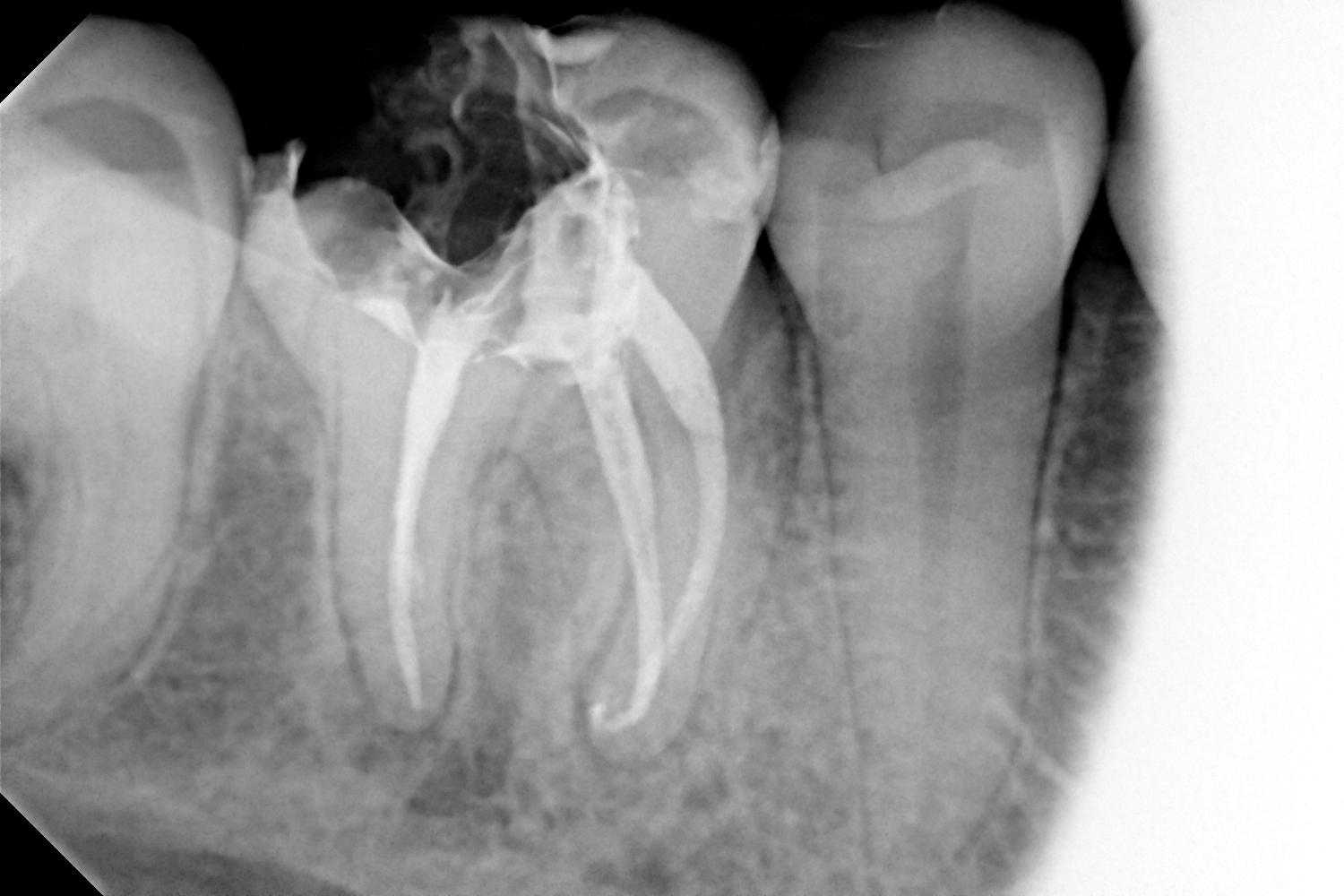 przypadek-3.-po-leczeniu-endodontycznym