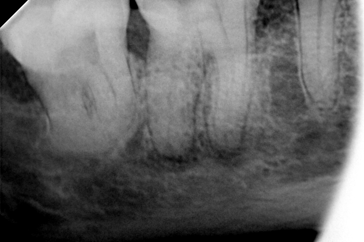 przypadek-3.-przed-leczeniem-endodontycznym